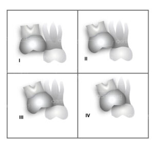 Impacção do primeiro molar superior permanente