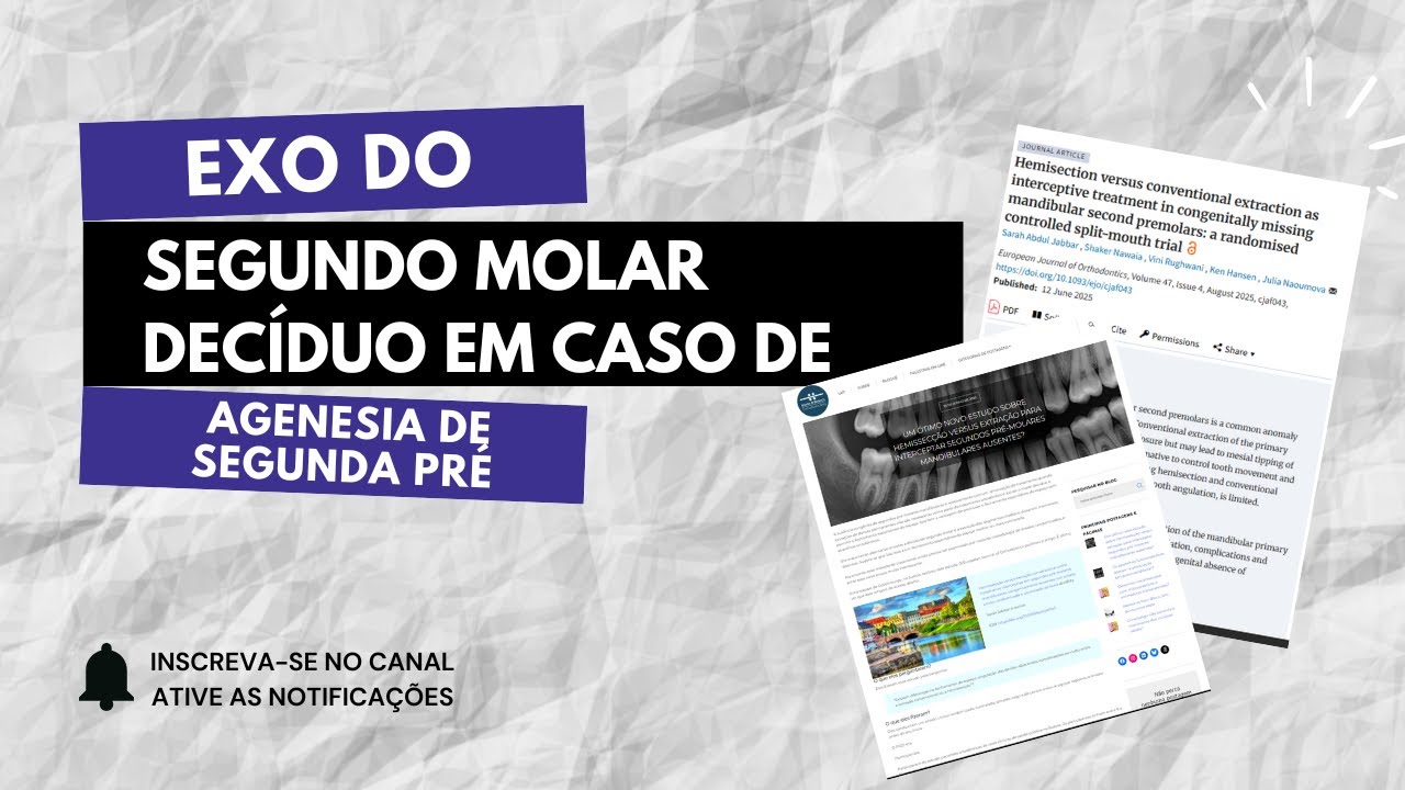 Exo do segundo molar decíduo, em caso se agenesia de segunda pré